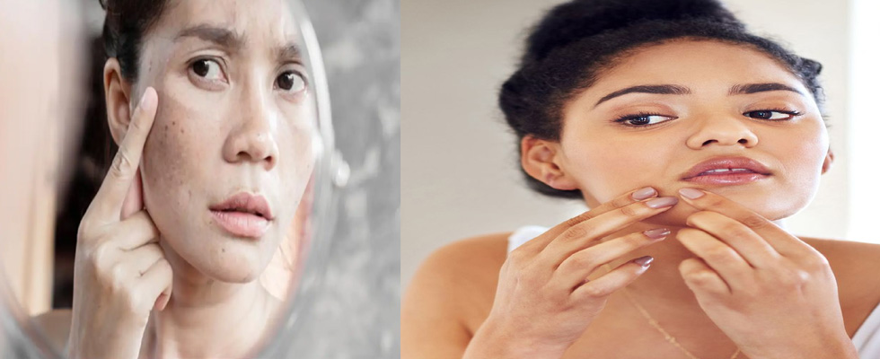 7 Best Cream For Pimples: Have  Clear and Radiant Skin